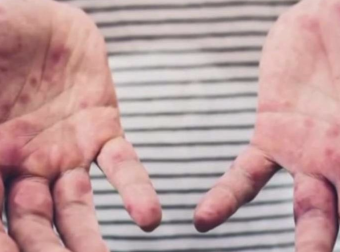 2025年宾州麻疹拉响警报，首例确诊于蒙哥马利县